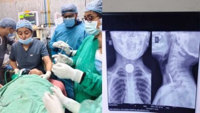 6 वर्षीय मासूम की आहार नली से सफलतापूर्वक निकाला गया सिक्का, बची जान 2 Docter 0