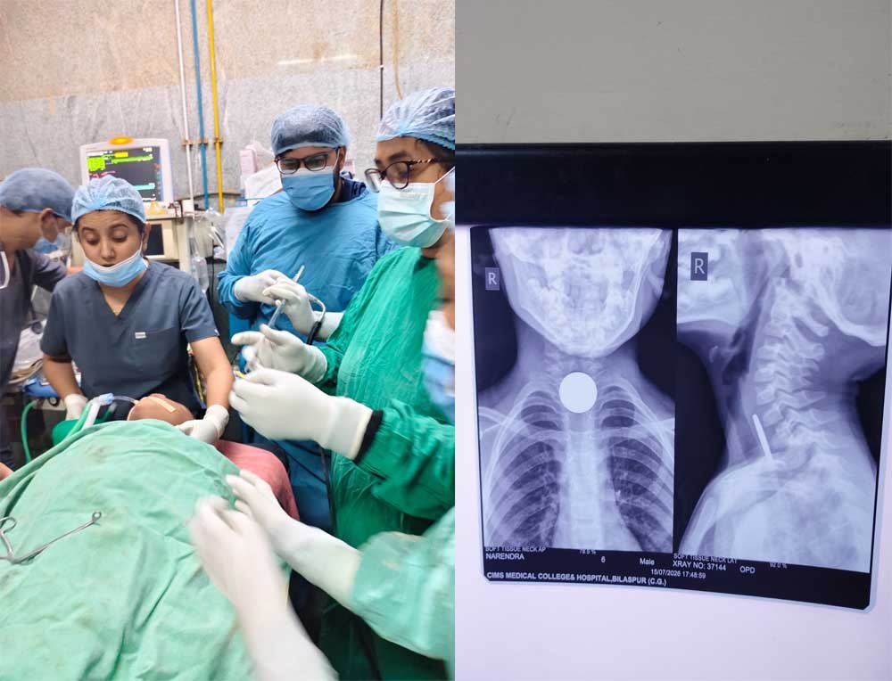 6 वर्षीय मासूम की आहार नली से सफलतापूर्वक निकाला गया सिक्का, बची जान 1 Docter 0