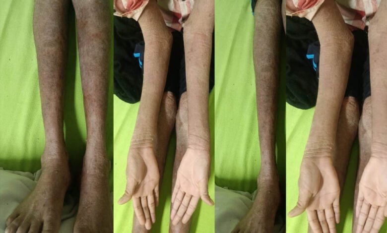 AIIMS रायपुर की बड़ी कामयाबी, ‘लाइलाज’ बीमारी का हुआ सफल उपचार; मरीज को मिली नई जिंदगी 6 13A 38 2